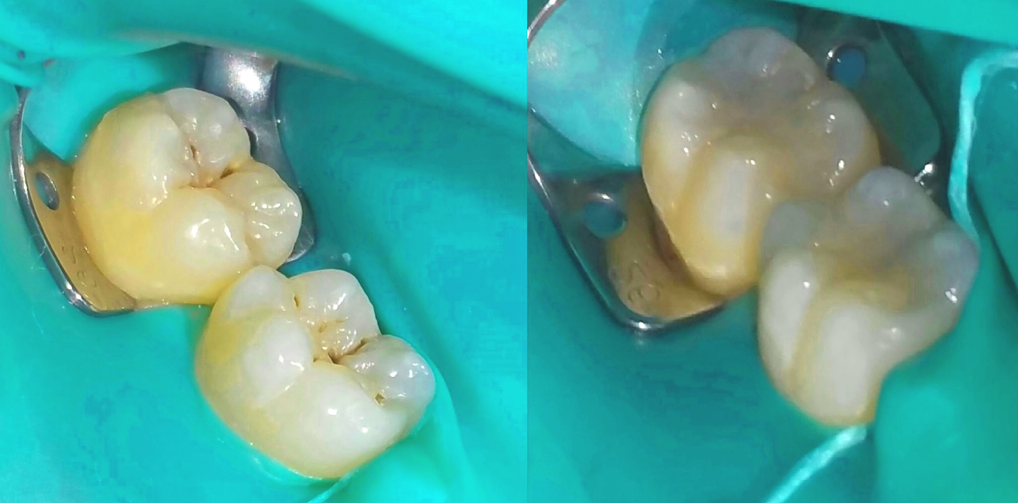 Composite Filling before and after